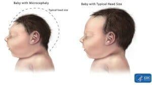 diagram showing baby with Microcephaly and a baby with typical head size