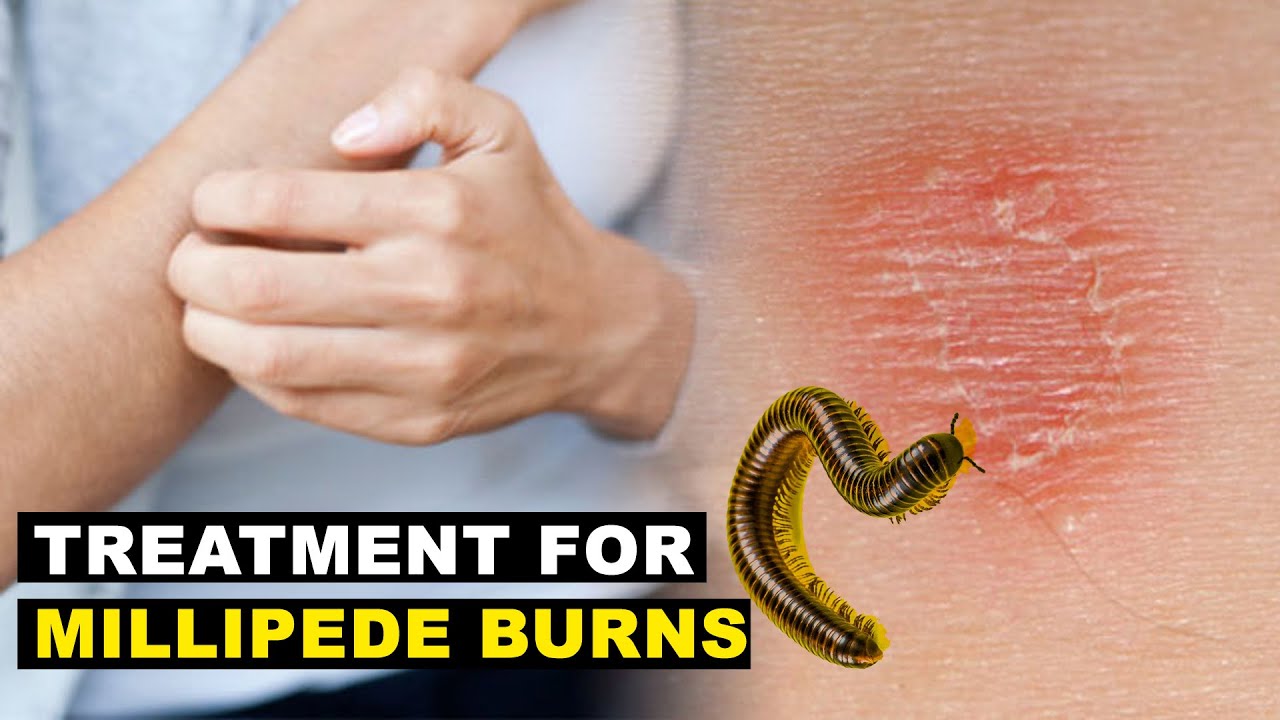 Best Treatment for Millipede Burns
