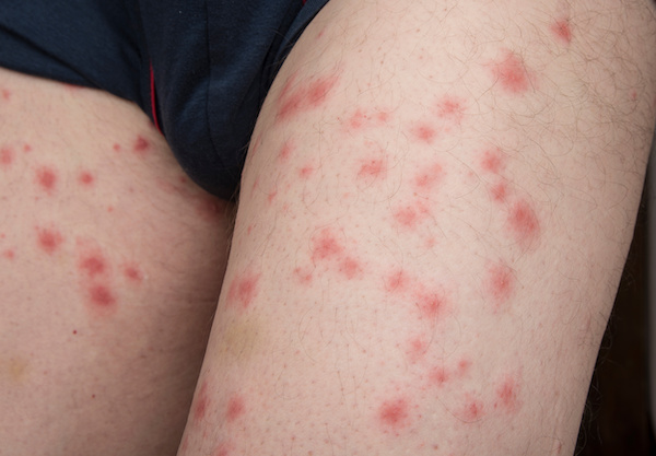Multiple bed bug bites on a person skin, one of the early signs of bed bugs