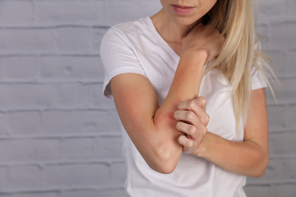Woman experiencing an allergic reaction to a bite by scratching the red bite