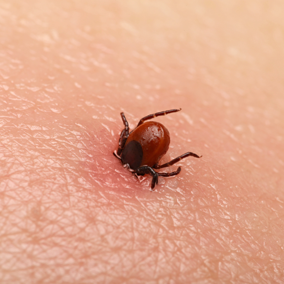 Tick burrowing into someone's skin