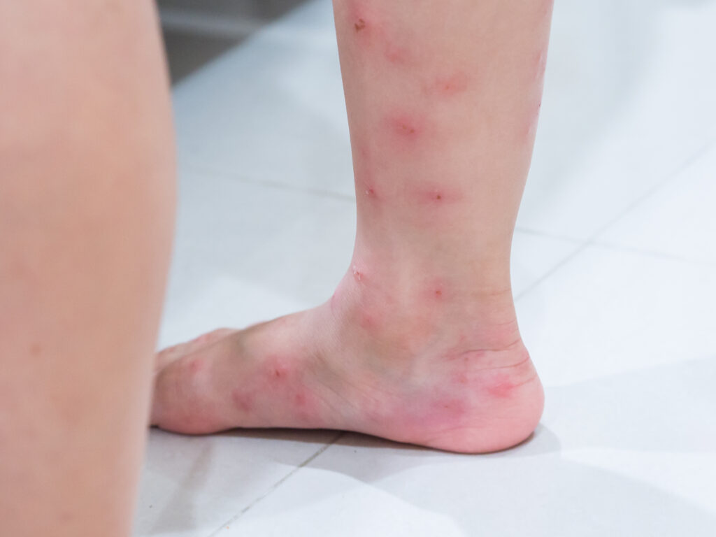 Ant bites