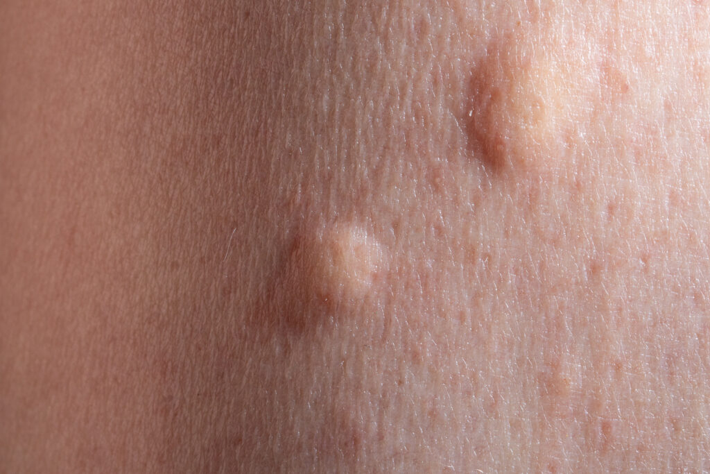 Mosquito bite